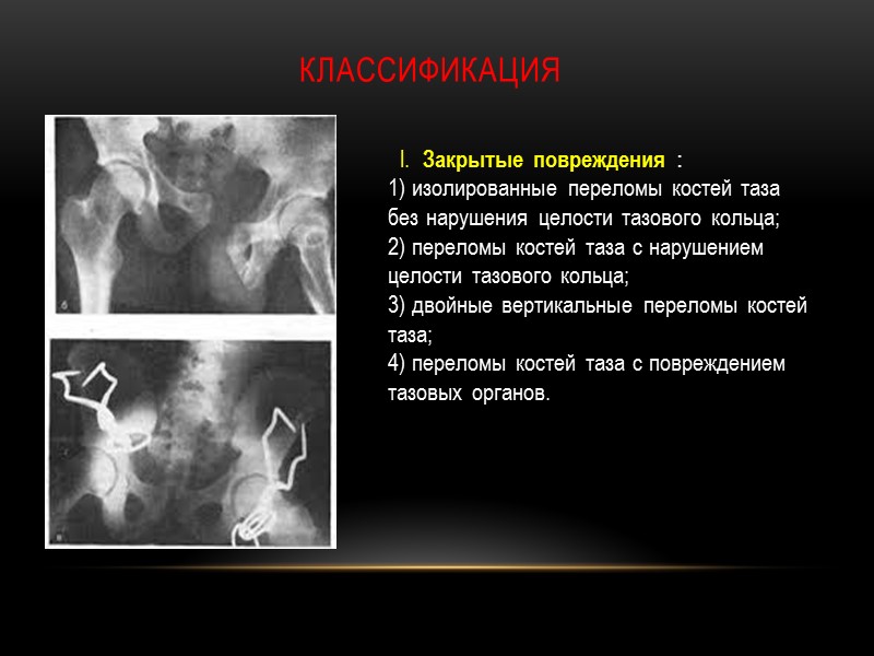 I.  Закрытые повреждения :  1) изолированные переломы костей таза без нарушения целости